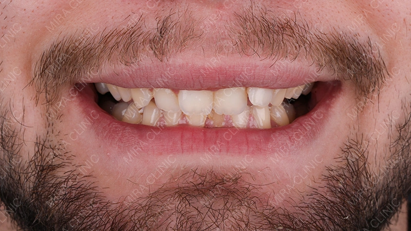 Hollywood smile Before Treatment